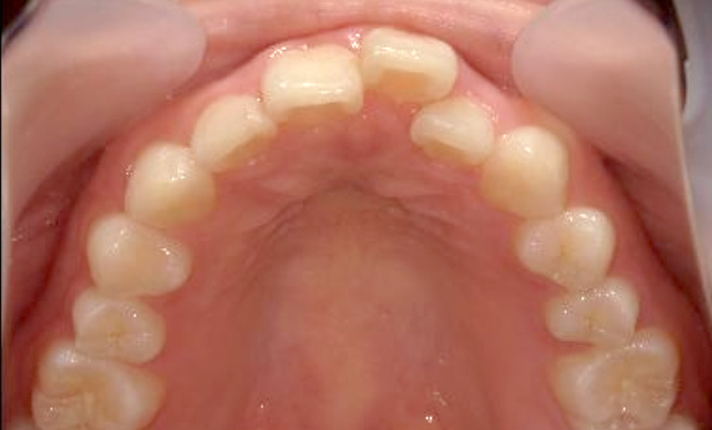 部分矯正 20代の症例写真