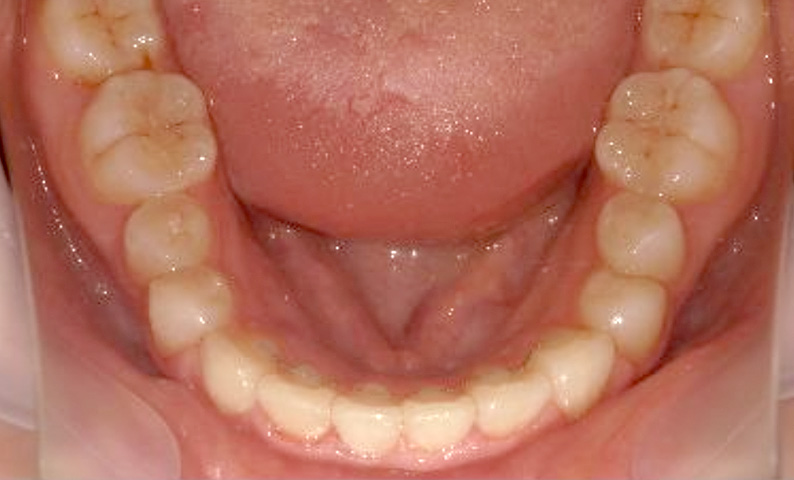 部分矯正 20代の症例写真