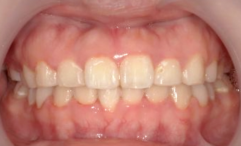 部分矯正 20代の症例写真