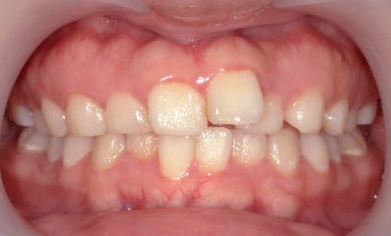 部分矯正 20代の症例写真