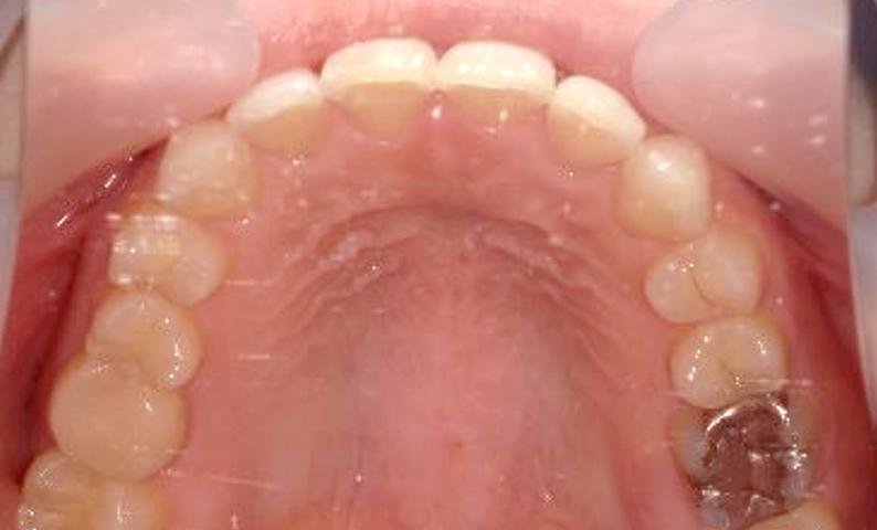 部分矯正 20代の症例写真