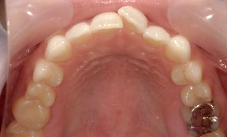 部分矯正 20代の症例写真