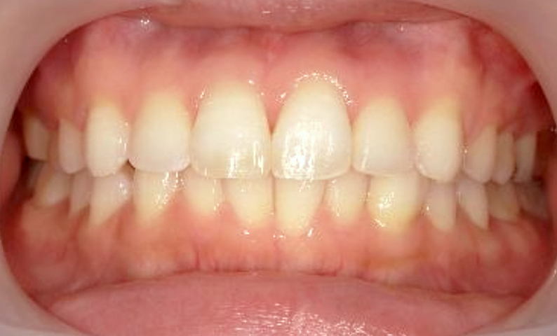 部分矯正 20代の症例写真