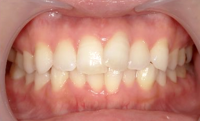 部分矯正 20代の症例写真