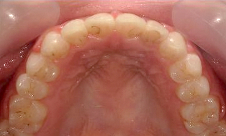 部分矯正 20代の症例写真