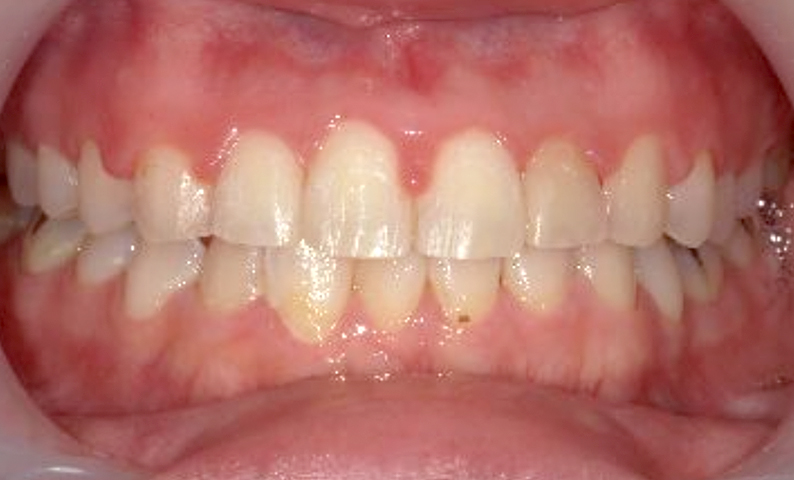 部分矯正 20代の症例写真