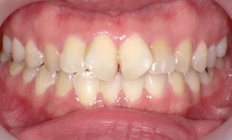 部分矯正 20代の症例写真