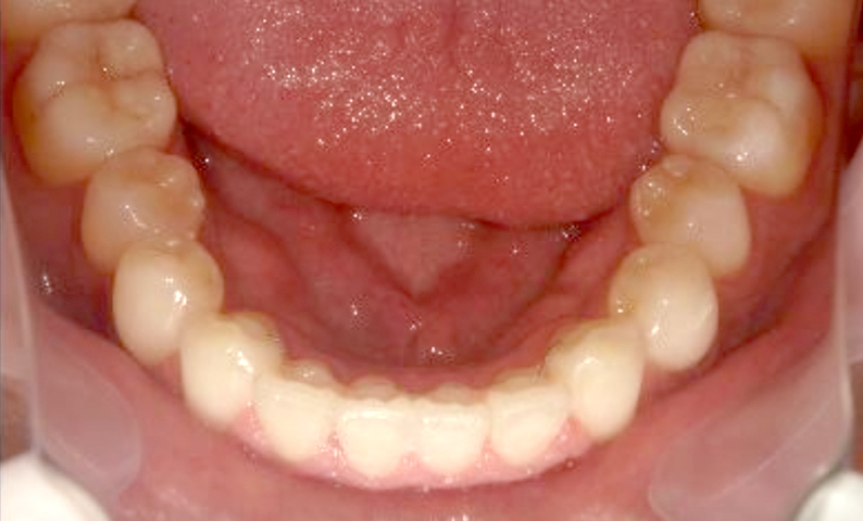 部分矯正 20代の症例写真