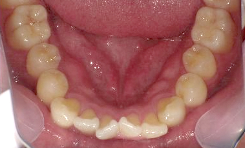 部分矯正 20代の症例写真