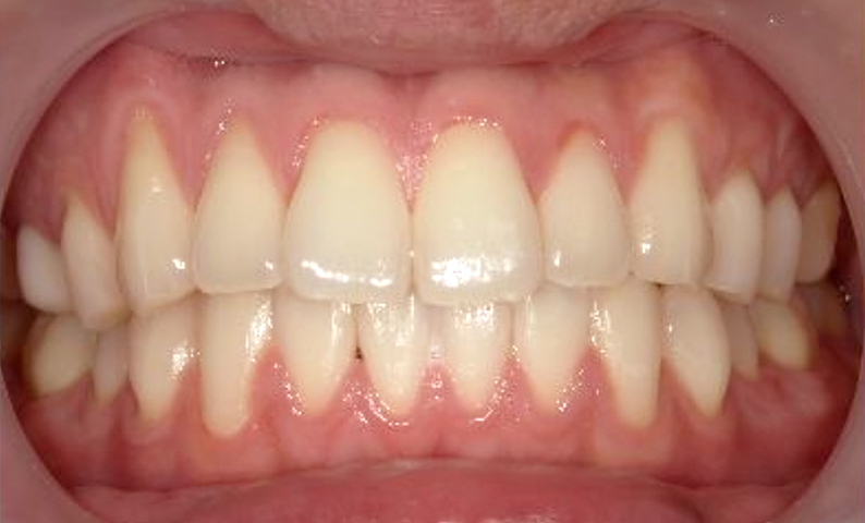 部分矯正 20代の症例写真