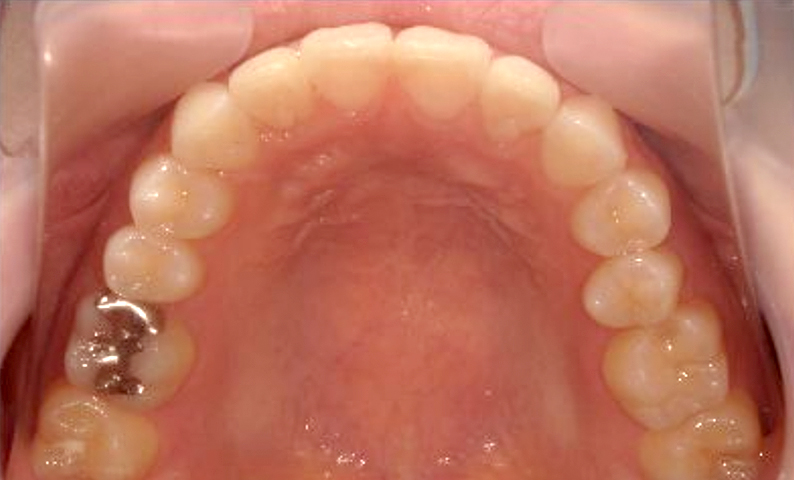 部分矯正 20代の症例写真