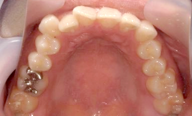 部分矯正 20代の症例写真