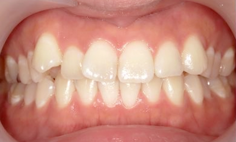 部分矯正 20代の症例写真