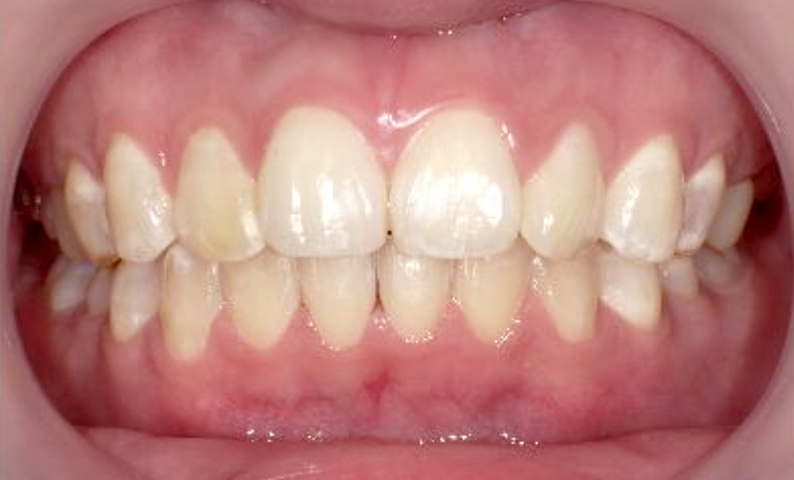 部分矯正の症例 八重歯