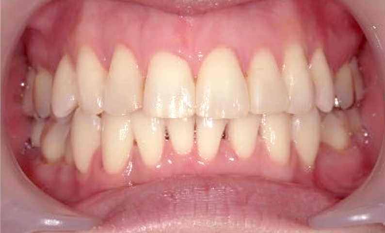 部分矯正の症例 すきっ歯