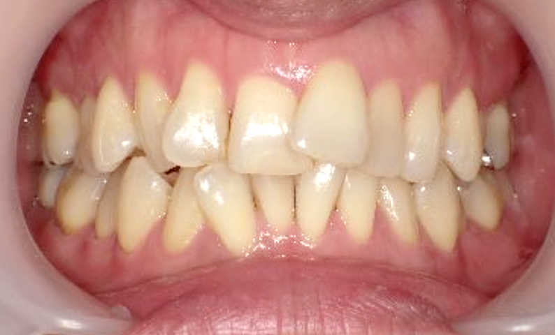 部分矯正の症例 すきっ歯