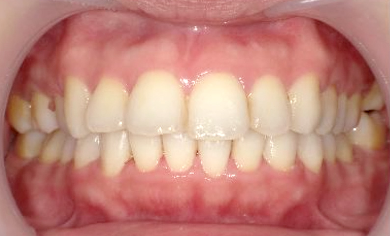 部分矯正 30代の症例写真