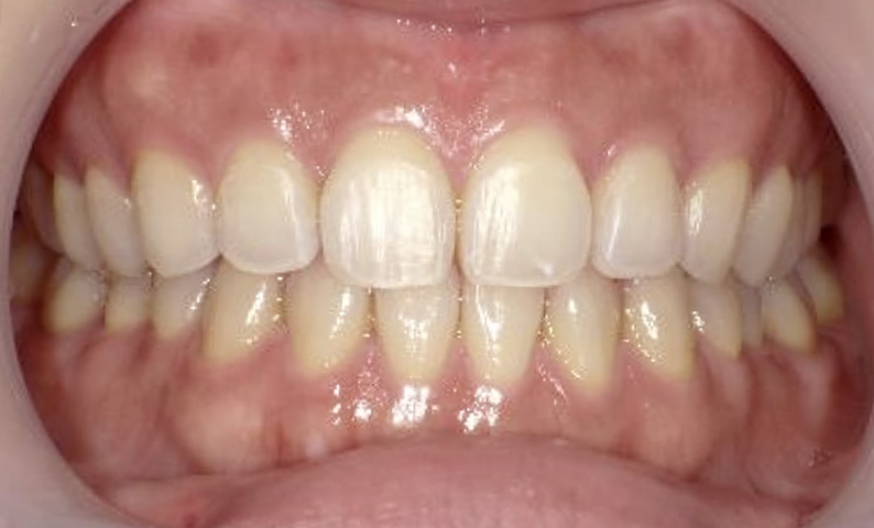 部分矯正の症例 すきっ歯