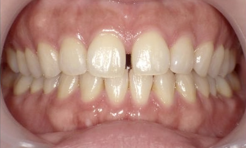 部分矯正の症例 すきっ歯