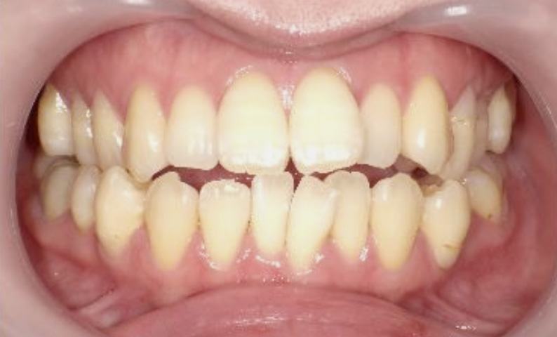 部分矯正 30代の症例写真