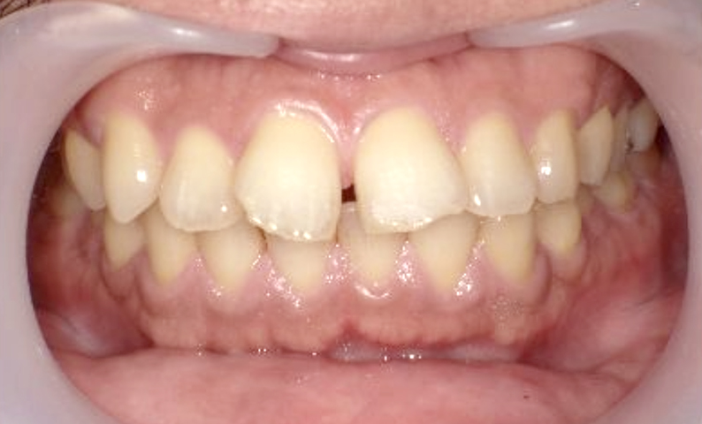 部分矯正 30代の症例写真