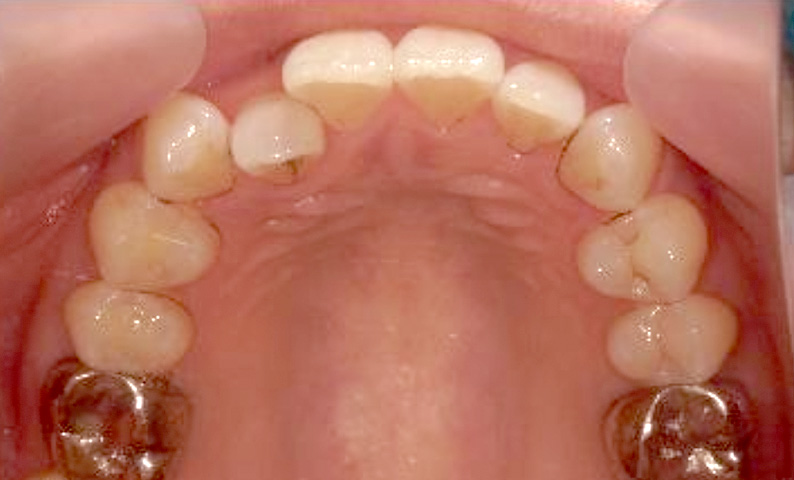 部分矯正 30代の症例写真