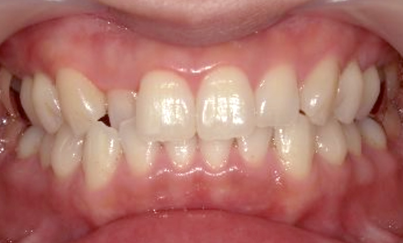 部分矯正 30代の症例写真