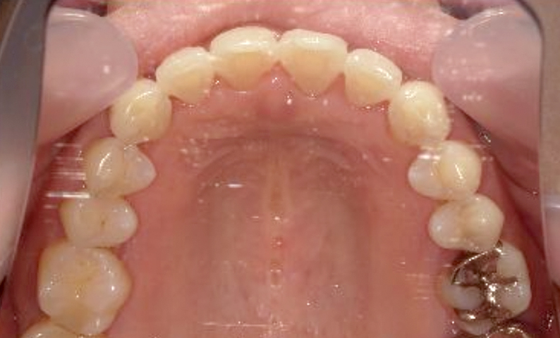 部分矯正 30代の症例写真