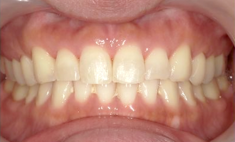 部分矯正 30代の症例写真