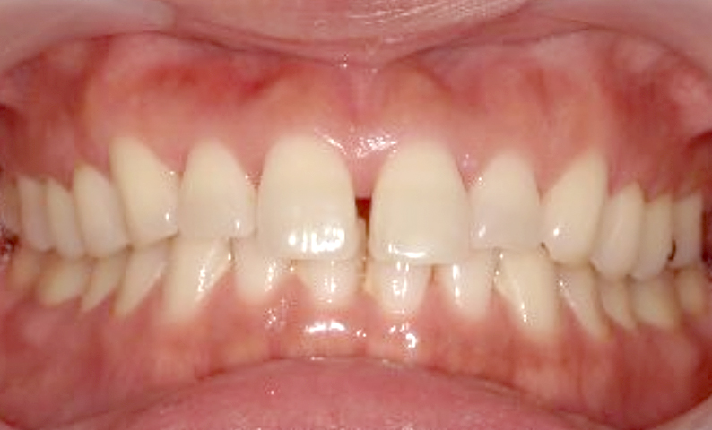 部分矯正 30代の症例写真