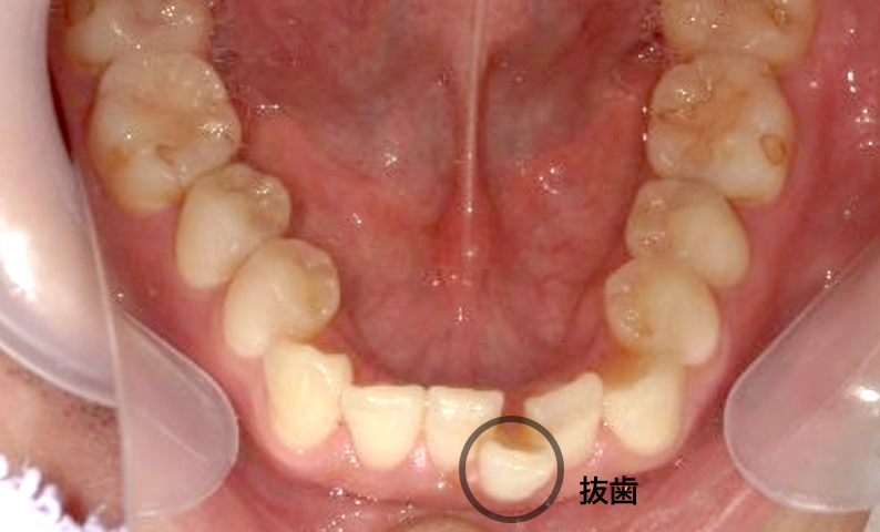 部分矯正 30代の症例写真