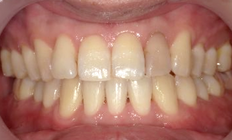 部分矯正 30代の症例写真