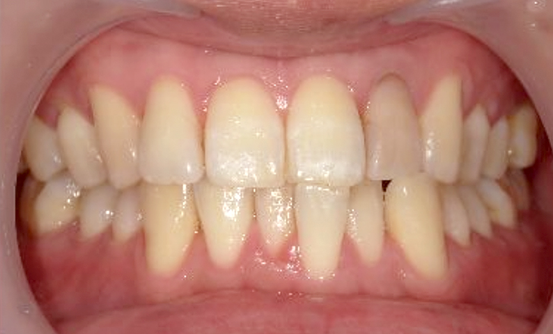 部分矯正 30代の症例写真