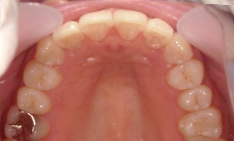 部分矯正 30代の症例写真