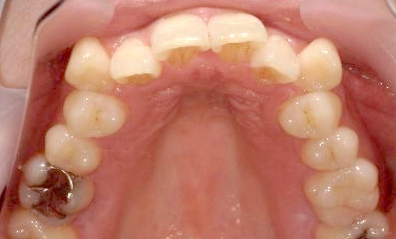 部分矯正 30代の症例写真