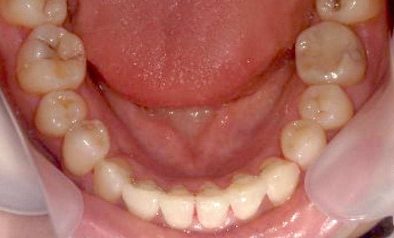 部分矯正 30代の症例写真