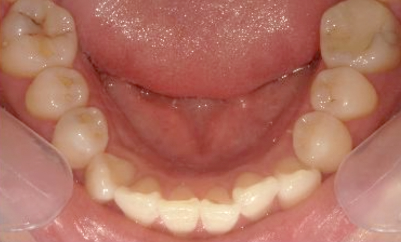 部分矯正 30代の症例写真