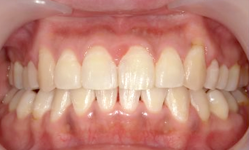 部分矯正 30代の症例写真