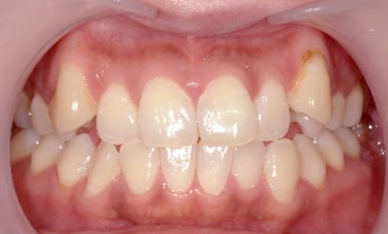 部分矯正 30代の症例写真