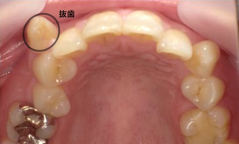 部分矯正 30代の症例写真