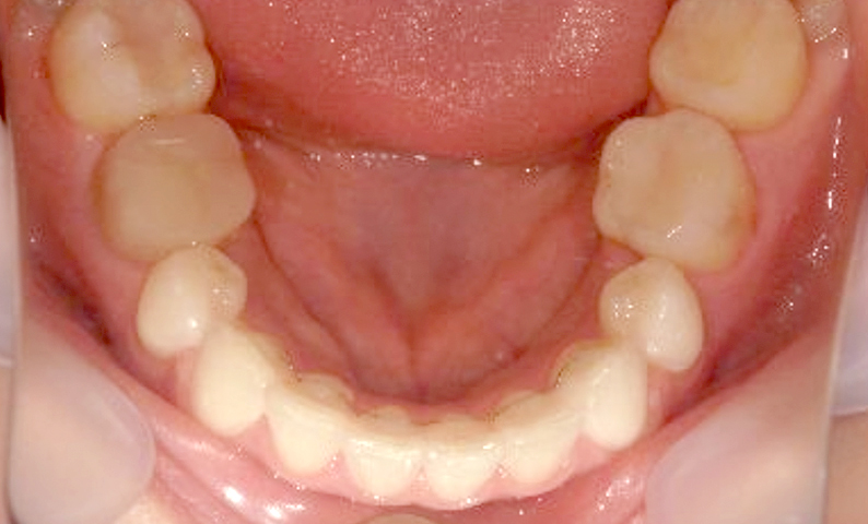 部分矯正 30代の症例写真