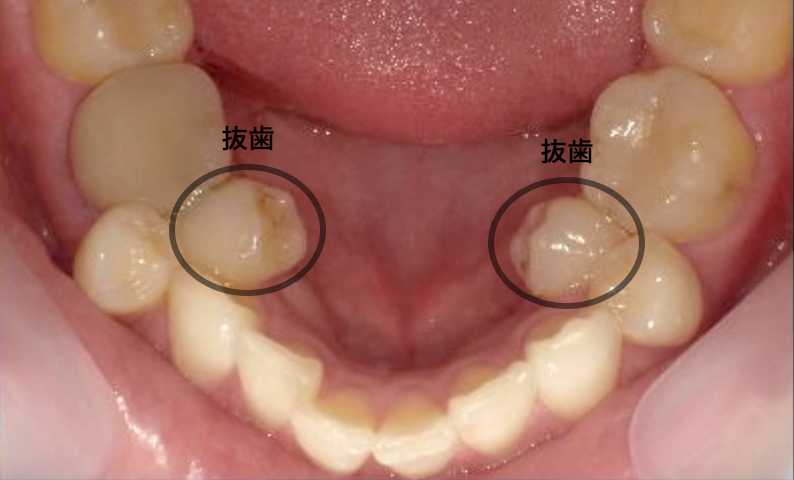 部分矯正 30代の症例写真