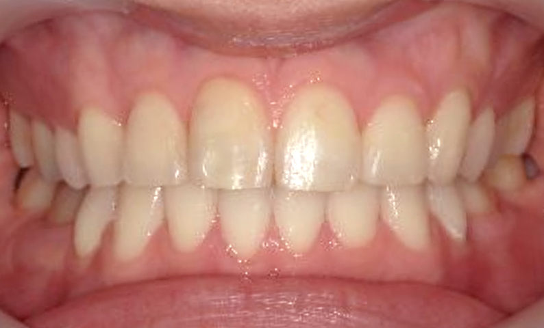 部分矯正 30代の症例写真