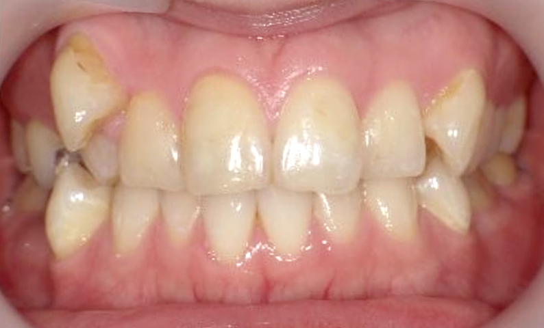 部分矯正 30代の症例写真