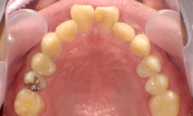 部分矯正 30代の症例写真