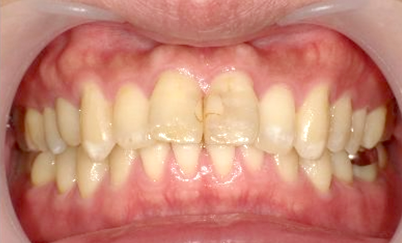 部分矯正 30代の症例写真