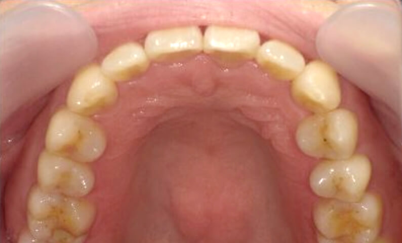 部分矯正 40代の症例写真