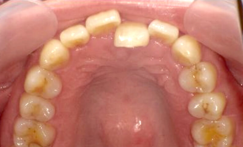 部分矯正 40代の症例写真