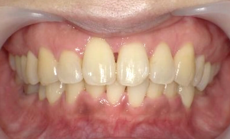 部分矯正 40代の症例写真