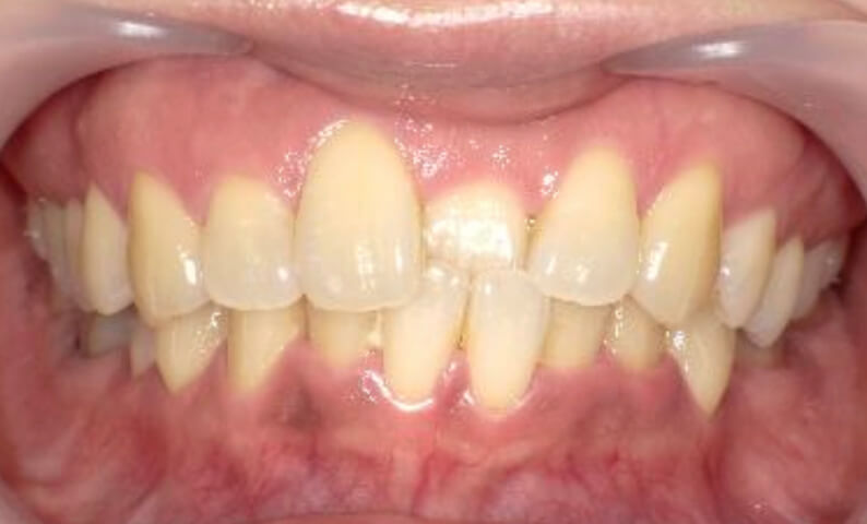 部分矯正 40代の症例写真